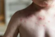 primeros casos de sarampión en Michoacán