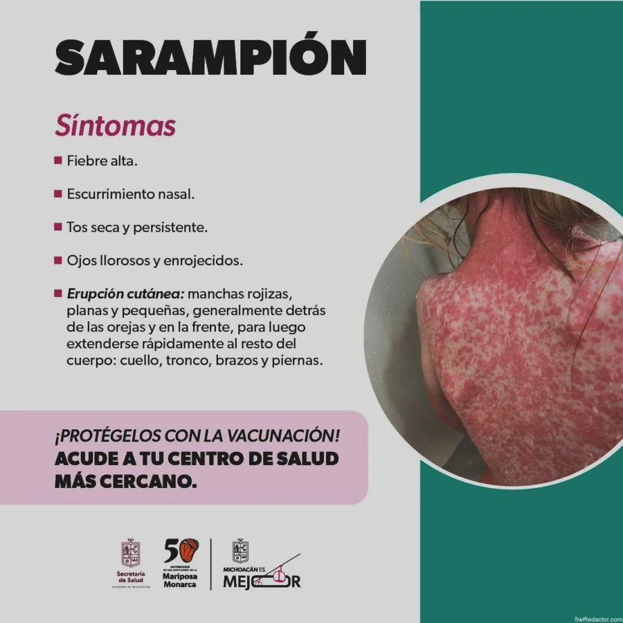 síntomas del sarampión